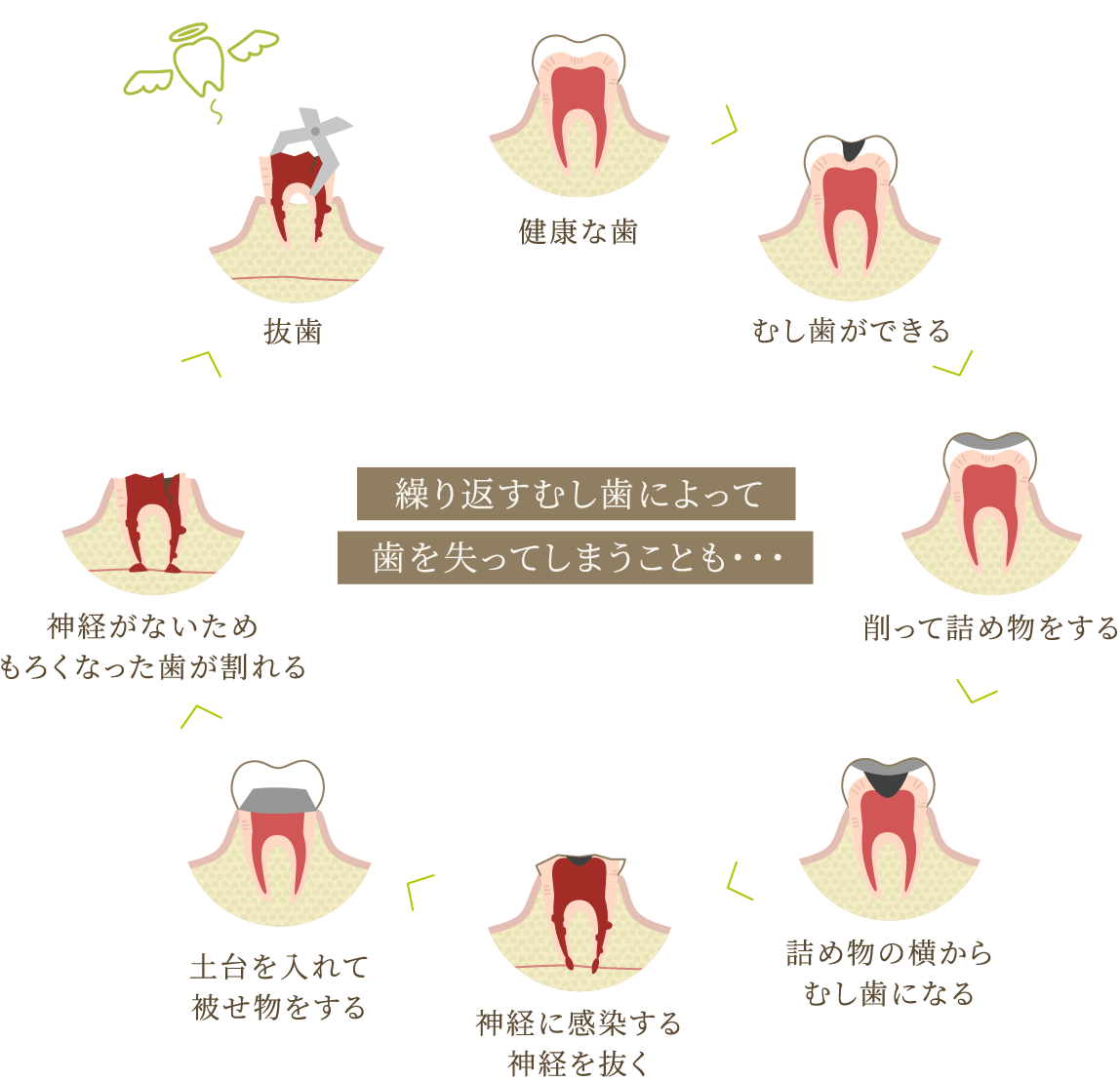 繰り返すむし歯によって歯を失ってしまうことも・・・